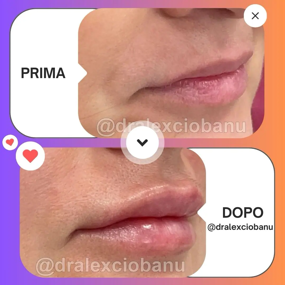 Filler labbra Acido ialuronico – Juvederm Ultra Smile