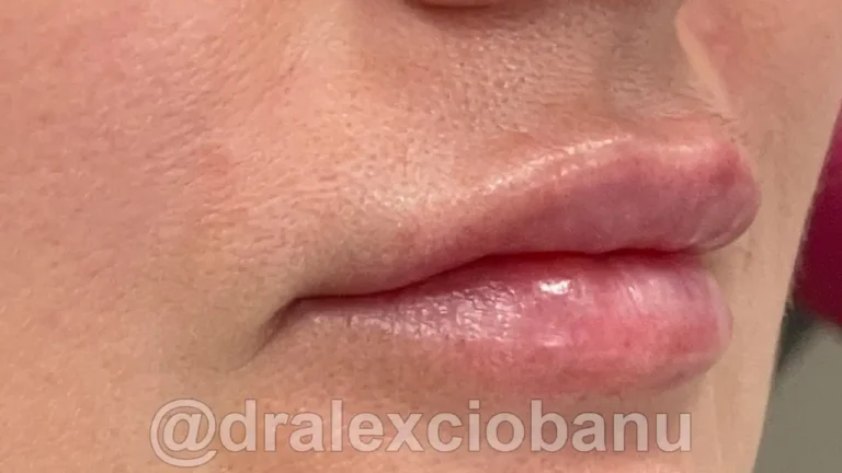 Filler labbra acido ialuronico - Juvederm Ultra Smile - Dopo