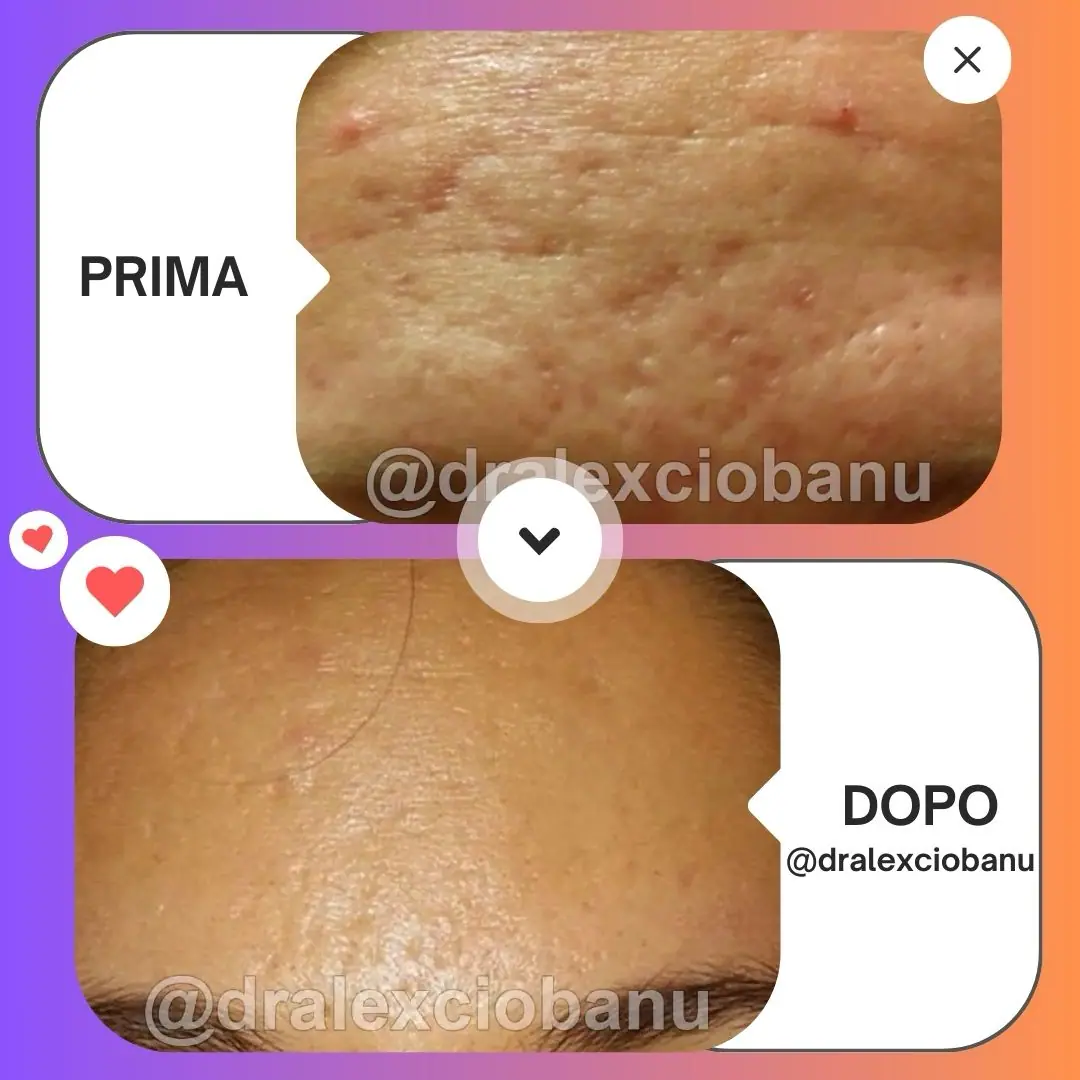 Microneedling SkinPen