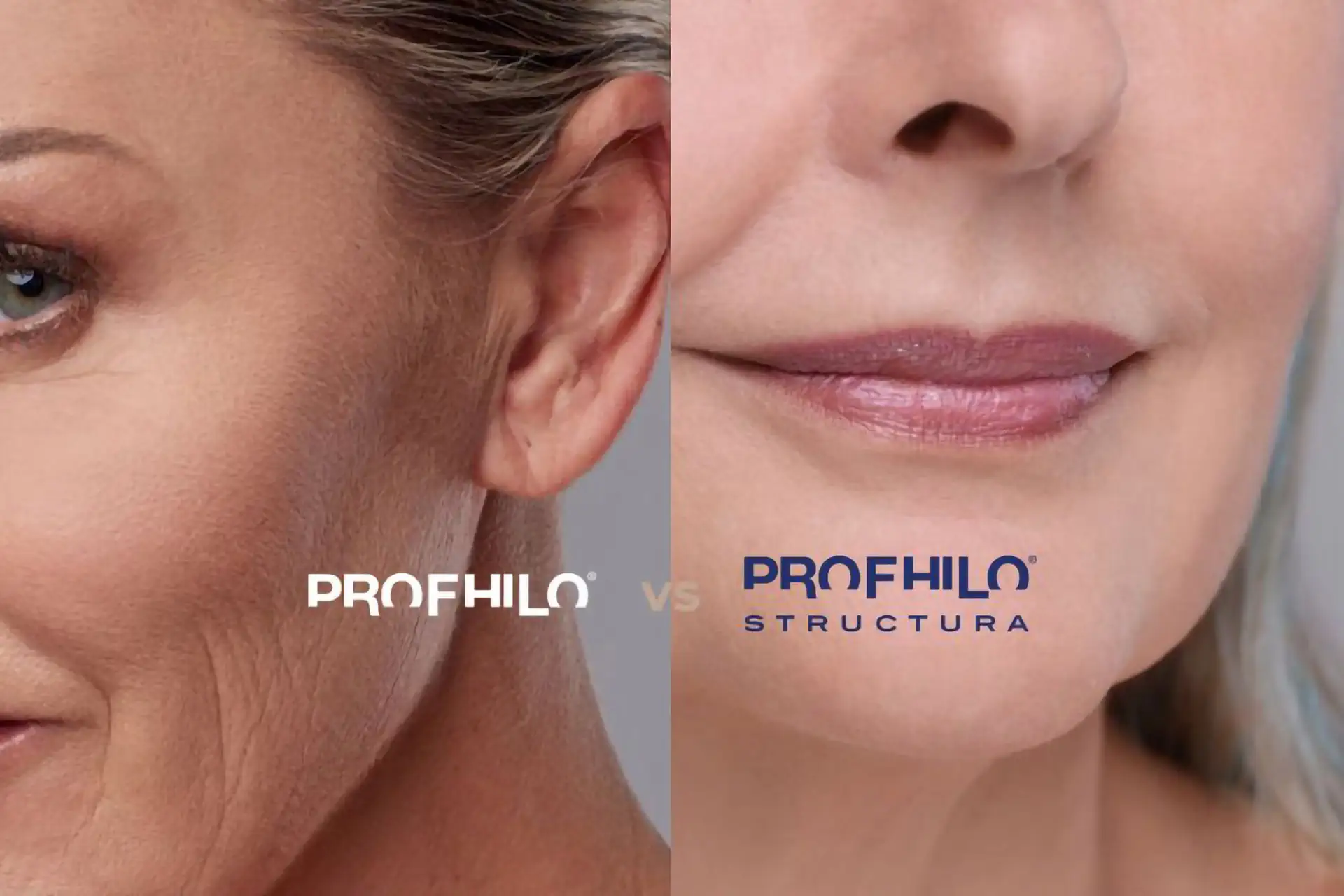 Profhilo vs Profhilo Structura